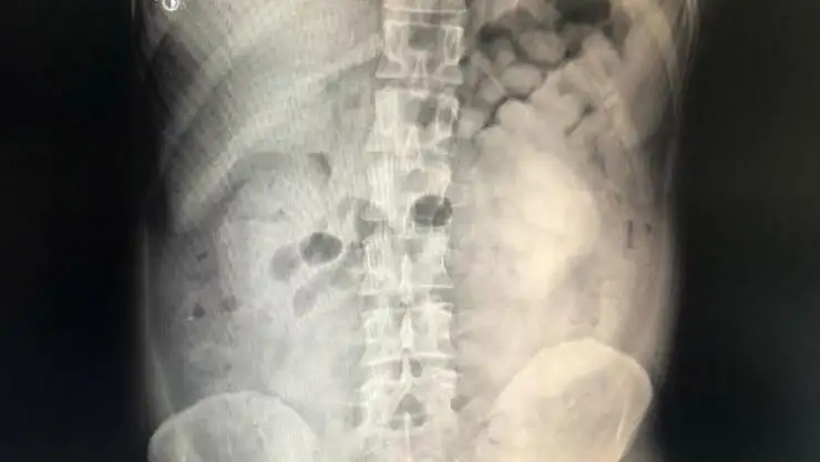 Diyarbakır'da şüpheli yolcunun midesinden 800 gram eroin çıktı